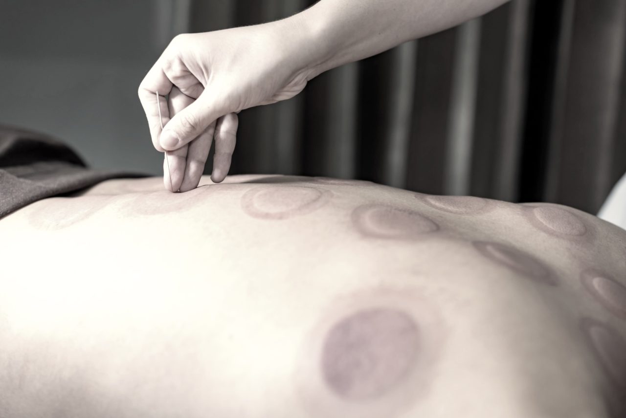 Massage aux ventouses anti cellulite